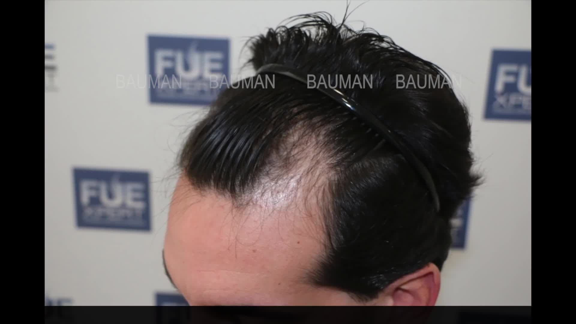 Cấy tóc tự thân FUE 2200 nang cho khách hàng nam hói đầu độ 2