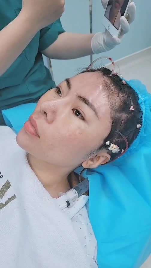 CA CĂNG DA TRÁN KẾT HỢP NÂNG CƠ ĐUÔI MẮT CHO KHÁCH HÀNG SAU 90 PHÚT