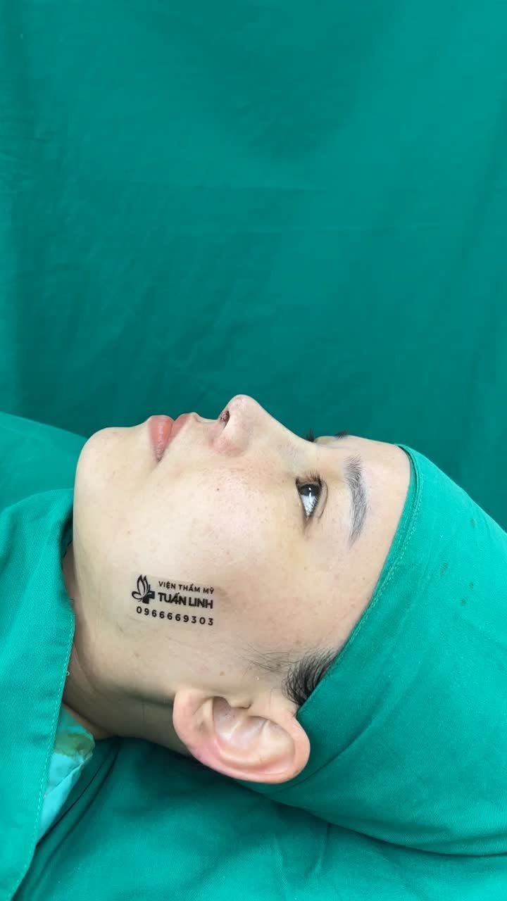 Nâng mũi cấu trúc lên dáng tự nhiên sau 90 phút
