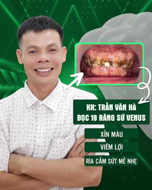 BAO NĂM MONG MUỐN MỘT HÀM RĂNG ĐỀU ĐẸP, TRẮNG SÁNG, ĐẾN NAY ĐÃ THÀNH HIỆN THỰC