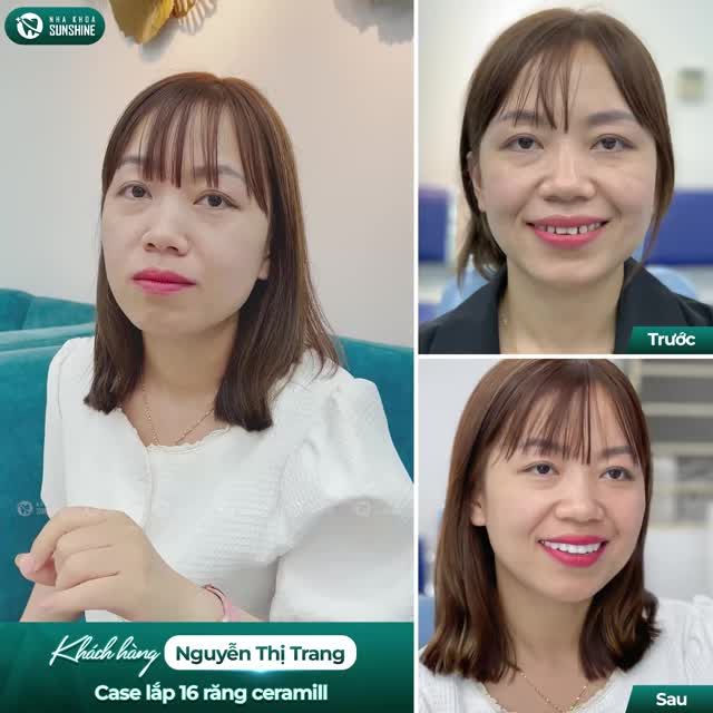 Biết răng thưa, xấu, đã tìm hiểu nhiều lần nhưng sợ đau nên không dám đi làm