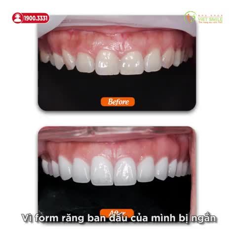 BỌC SỨ HT SMILE THỦ CÔNG - THAY MÀU, ĐỔI DÁNG, NỤ CƯỜI TỰ TIN