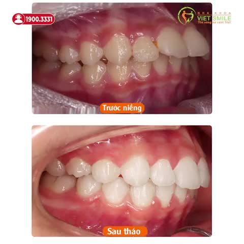 CẢM XÚC SAU THÁO NIỀNG RĂNG HÔ SAU 2 NĂM