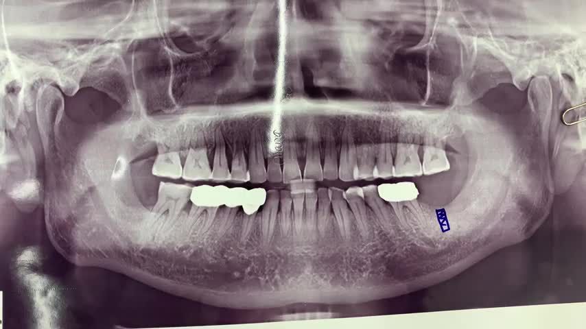 Cấy chân răng nhân tạo khôi phục lại răng 37.