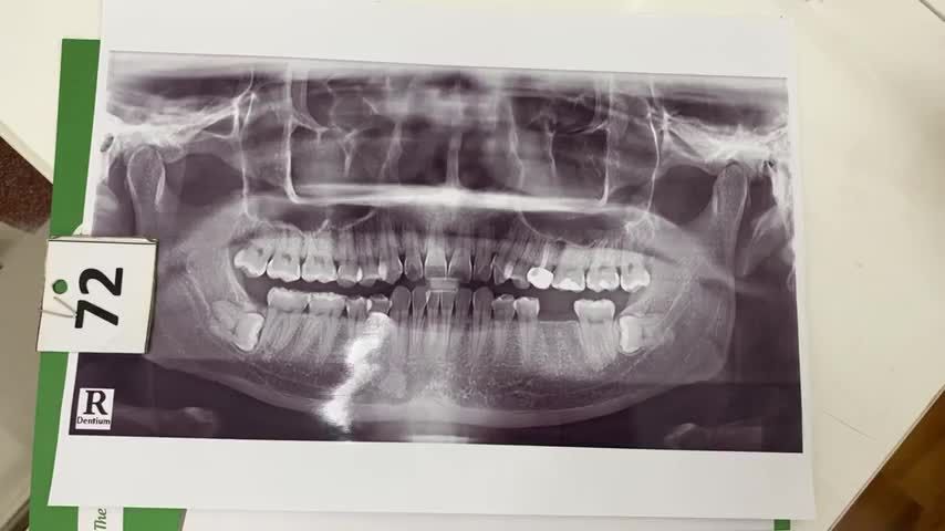 Cấy ghép Implant răng 36 cho khách hàng tại Nha Khoa Thuỳ Anh.