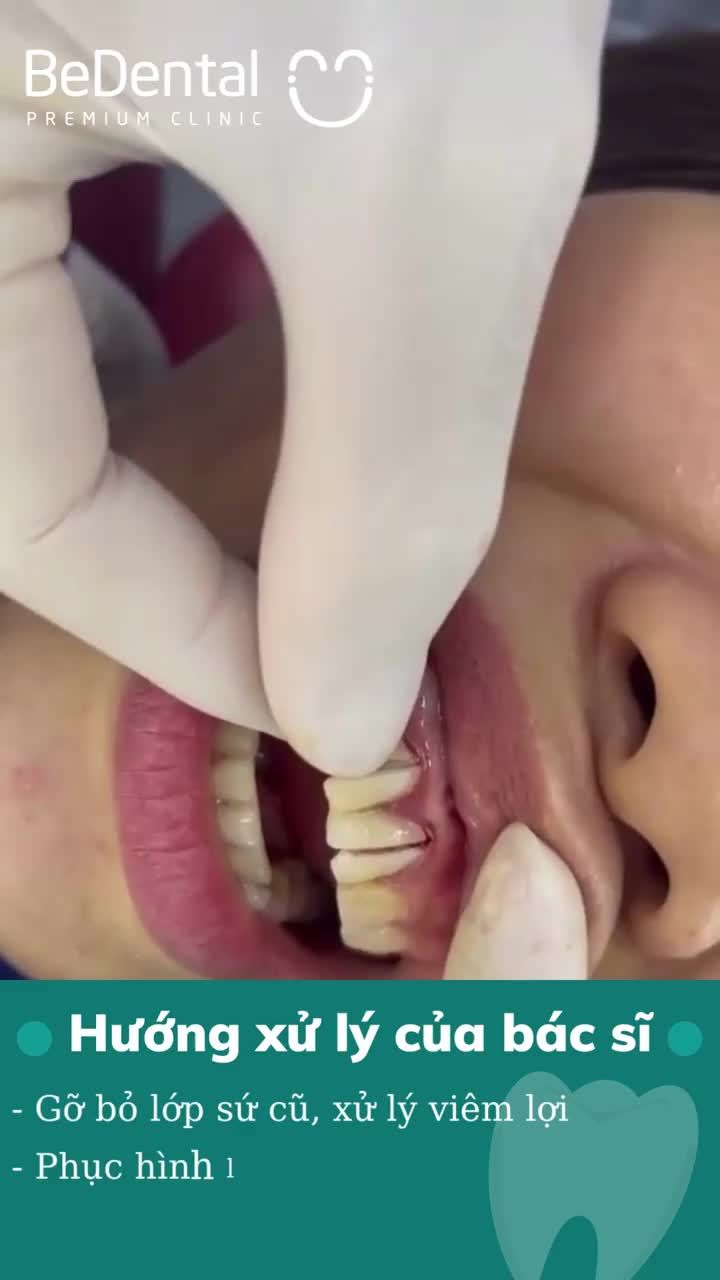 Chị khách hàng được người quen giới thiệu đến Nha khoa Bedental phục hình thẩm mỹ 16 răng sứ Đức