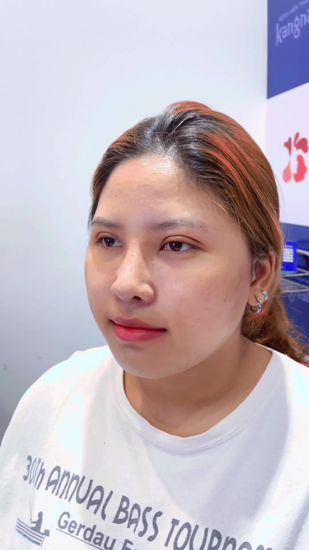 Combo xinh đẹp: Cắt mí trên Plasma Plus  Nâng mũi cấu trúc 6D không đau