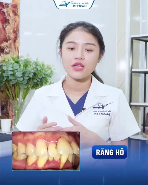 GIAI ĐOẠN NÀO XẤU NHẤT KHI NIỀNG RĂNG