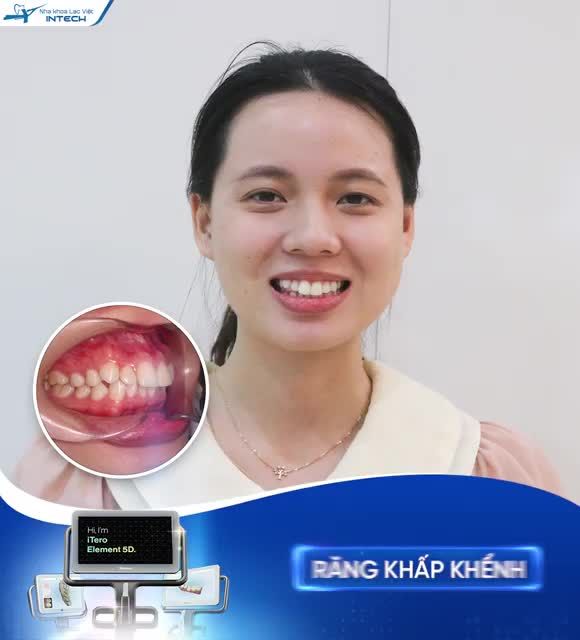 INVISALIGN – THAY ĐỔI NỤ CƯỜI, CHẲNG LO TRỞ NGẠI