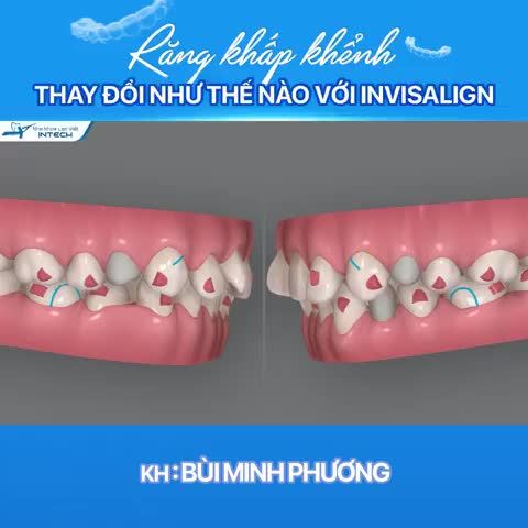 INVISALIGN – TÌM LẠI SỰ TỰ TIN TRONG BẠN!