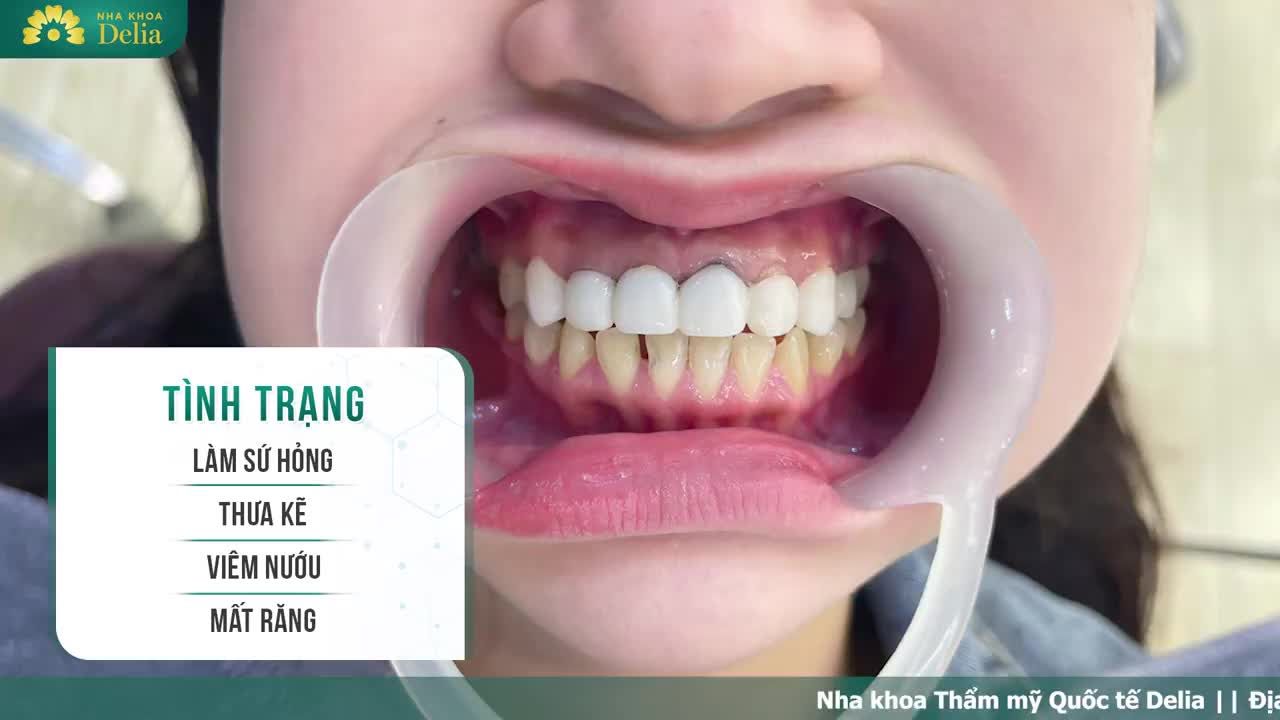 Kết quả sau khi chị Kim Duyên có nụ cười mới khỏe mạnh, rạng rỡ.