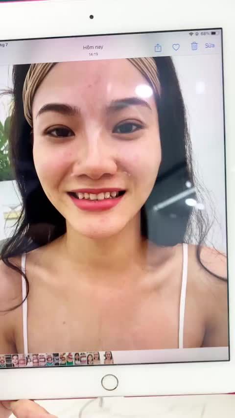 KH vừa hoàn thành lắp răng sứ thẩm mỹ