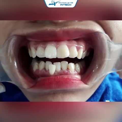 KHẮC PHỤC HOÀN TOÀN RĂNG HÔ BẰNG CÔNG NGHỆ X- MATRIX