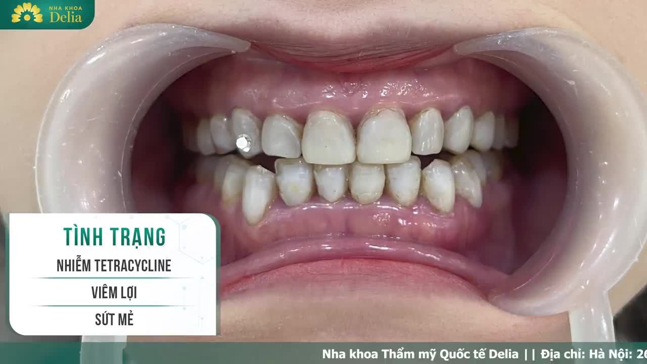 Khách hàng Nguyễn Thị Minh Hạnh răng bị nhiễm tetracycline, đã  từng phủ 1 lớp nhựa composite từ năm 2004,