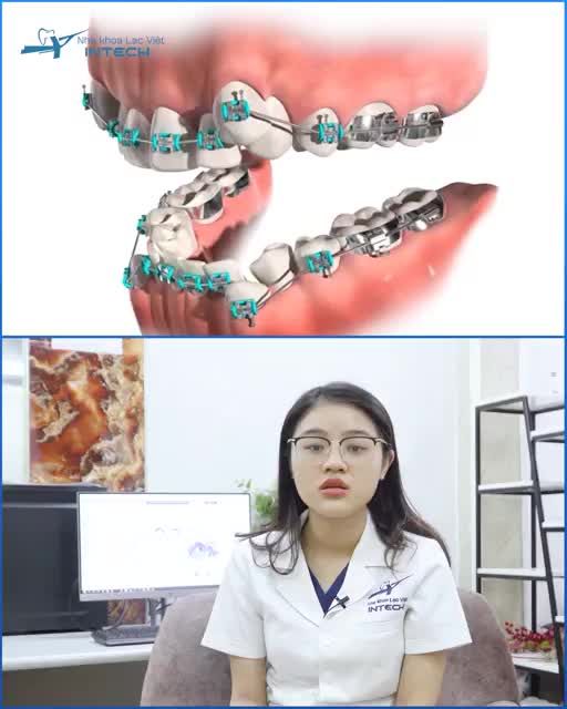 KHI NÀO CẦN NHỔ RĂNG ĐỂ NIỀNG RĂNG
