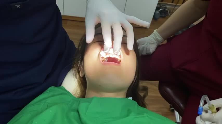 Lắp răng sứ cải thiện răng sứt mẻ cho bạn khách hàng tại Nha Khoa Thuỳ Anh.