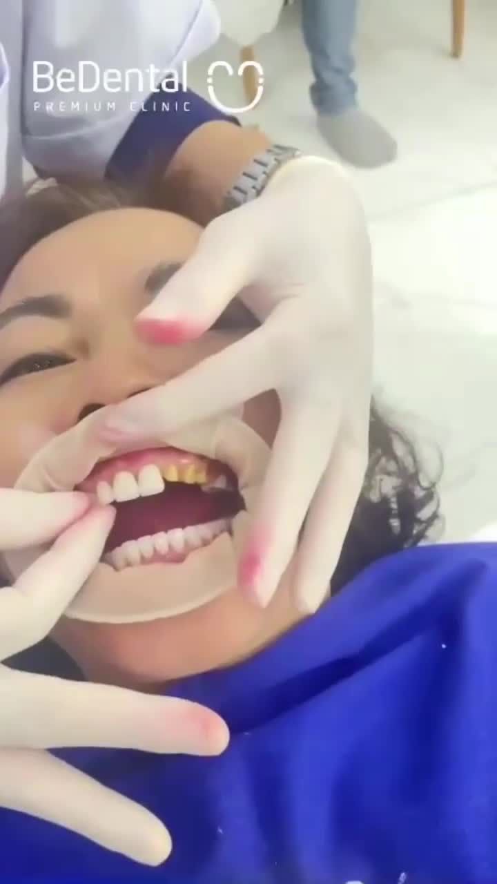 Một case đúng nghĩa đập đi xây lại với 28 đơn vị răng sứ cao cấp Đức