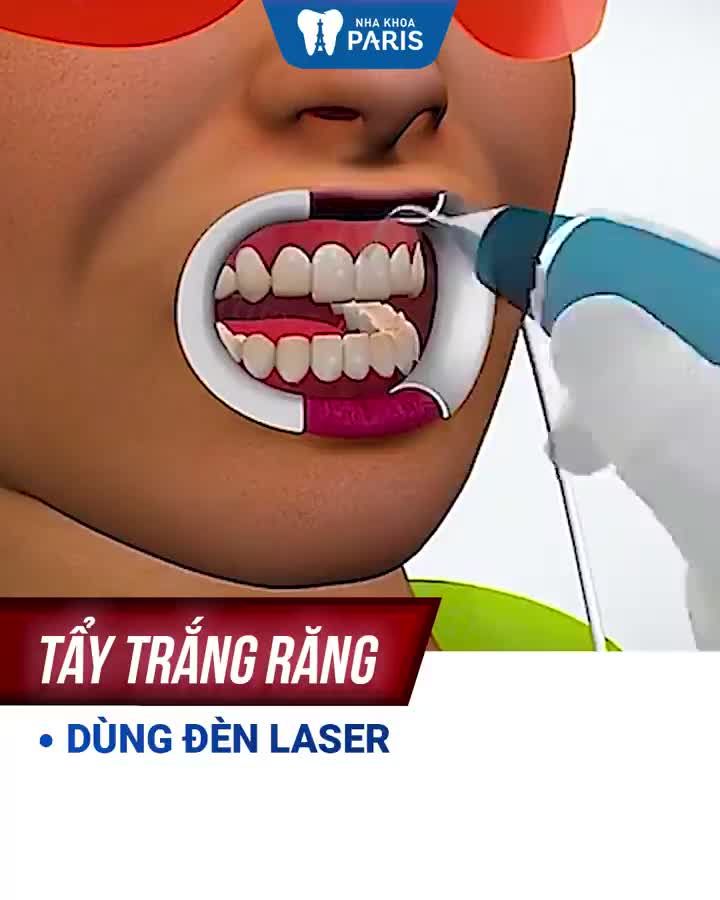 Nên Tẩy Trắng Răng hay Làm Răng Sứ