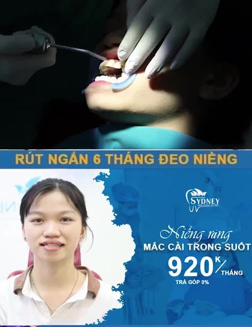 NIỀNG RĂNG CÓ HẠI KHÔNG