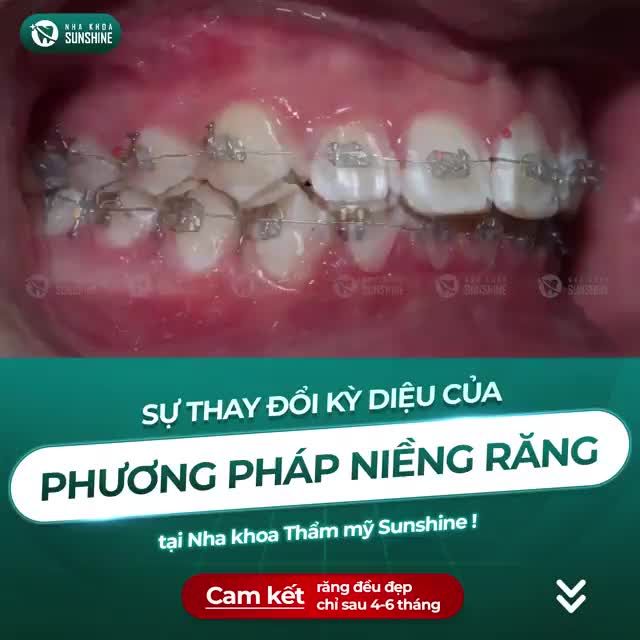 Niềng răng mắc cài vừa nhanh chóng lại tiết kiệm chi phí