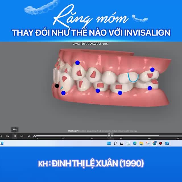 NIỀNG RĂNG MÓM KHÔNG CẦN NHỔ RĂNG VỚI INVISALIGN!