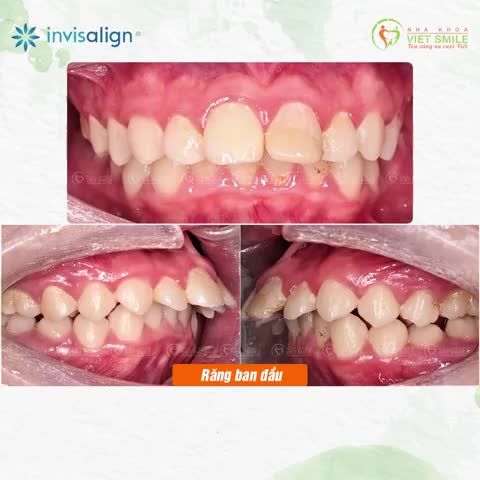 NIỀNG RĂNG TRONG SUỐT INVISALIGN TEEN - KHẮC PHỤC RĂNG HÔ TRẺ EM