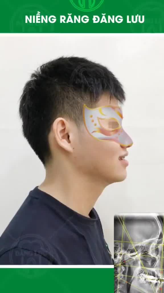 Nụ cười tự tin hàm răng đều đặn, chuẩn khớp cắn sau khi niềng răng tại Nha Khoa Đăng Lưu