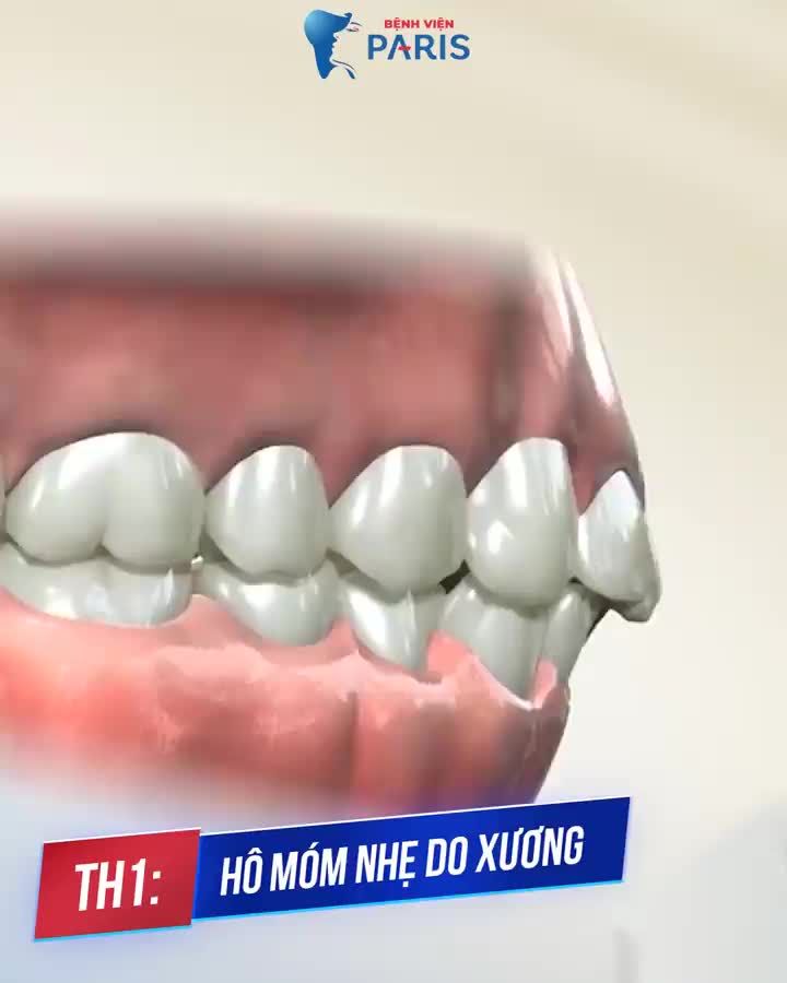 Phẫu thuật Hàm mặt theo chuẩn Pháp cùng bộ đôi chuyên gia