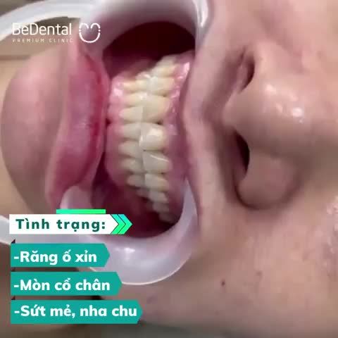 Quy trình hoàn thiện nụ cười cho chị khách hàng chi nhánh Sài Gòn