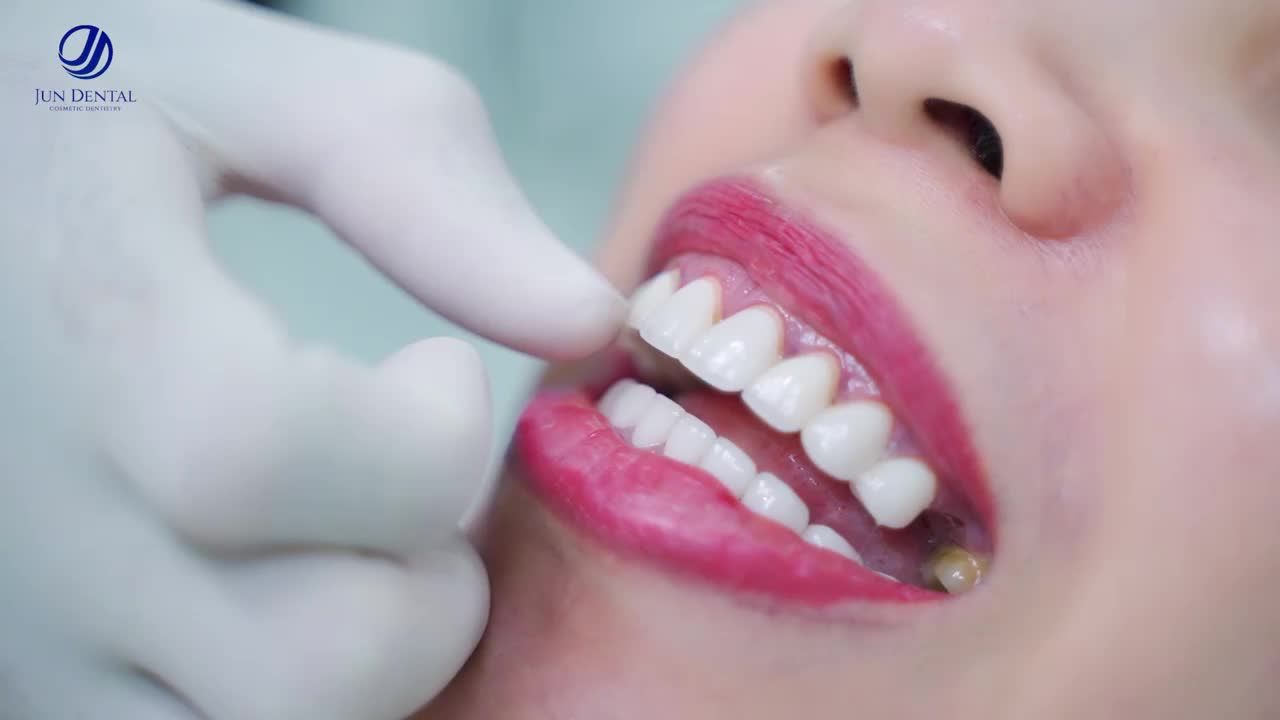 Răng đều, đẹp, trắng sáng tự nhiên phù hợp với khuôn mặt của chị Phượng