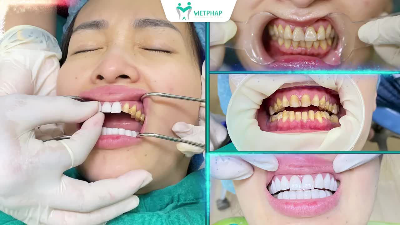 RĂNG NHIỄM TETRACYLINE CÓ DÁN SỨ VENEER ĐƯỢC KHÔNG