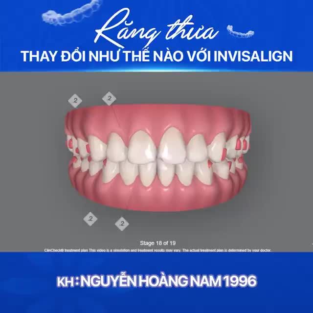 RĂNG THƯA THAY ĐỔI NHƯ THẾ NÀO VỚI INVISALIGN