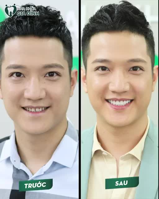 RĂNG TRẮNG RẠNG NGỜI - THẦN SẮC TƯƠI TRẺ