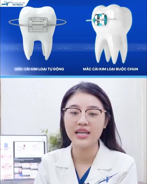 SO SÁNH NIỀNG RĂNG MẮC CÀI BUỘC CHUN VÀ MẮC CÀI TỰ ĐỘNG
