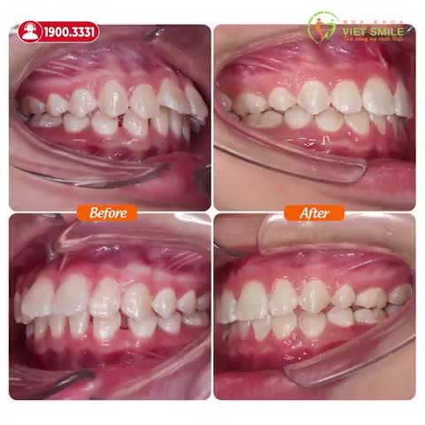 THÁO NIỀNG RĂNG THƯA, HÔ - TỰ TIN CƯỜI THOẢI MÁI