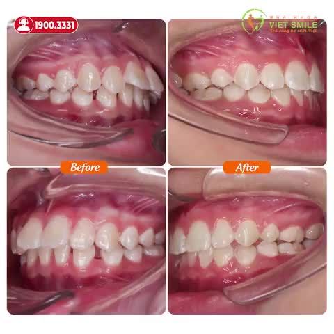 THÁO NIỀNG RĂNG THƯA, HÔ - TỰ TIN CƯỜI THOẢI MÁI