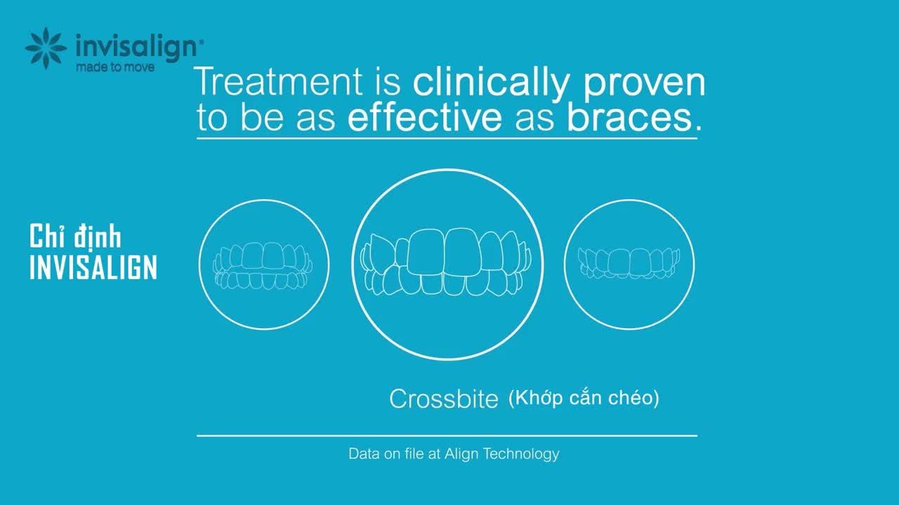 TÌNH TRẠNG RĂNG CỦA BẠN CÓ PHÙ HỢP ĐỂ NIỀNG RĂNG INVISALIGN