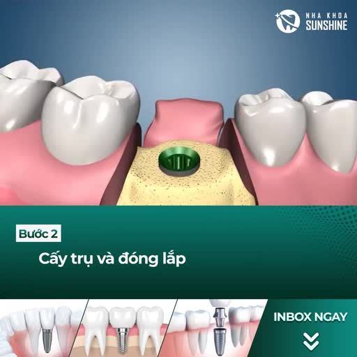 Trồng răng có thật sự đ.a.u và phức tạp như chúng ta vẫn nghĩ