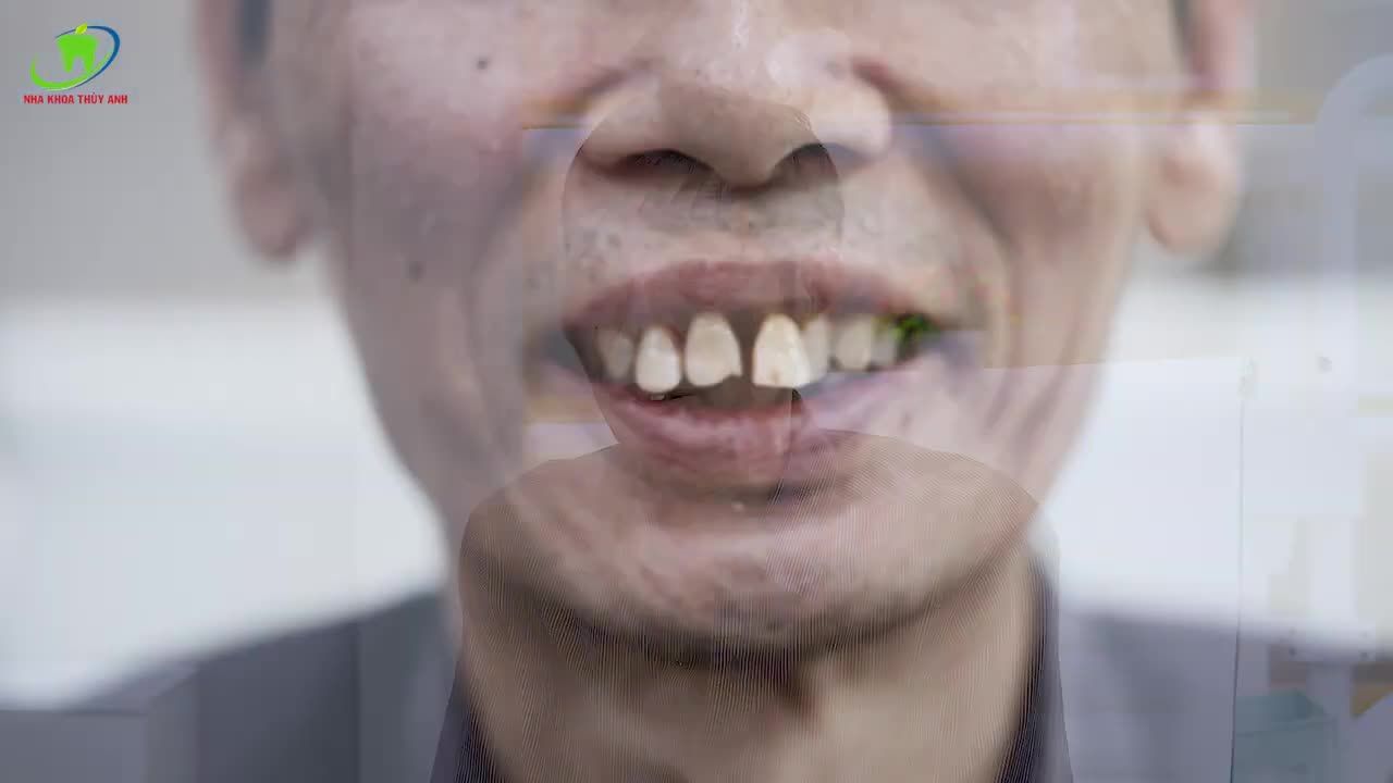 TRỒNG RĂNG IMPLANT - CẢI THIỆN ĂN NHAI, NÂNG CAO SỨC KHOẺ