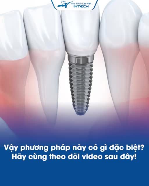 TRỒNG RĂNG IMPLANT CÓ GÌ ĐẶC BIỆT