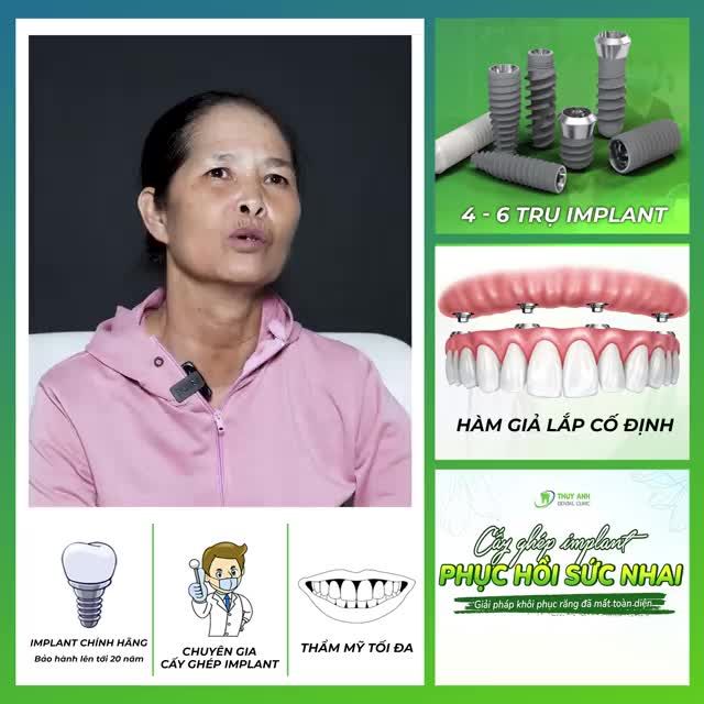TRỒNG RĂNG TOÀN HÀM ALL ON 4 - RĂNG CHẮC KHỎE - THẨM MỸ TỐI ĐA