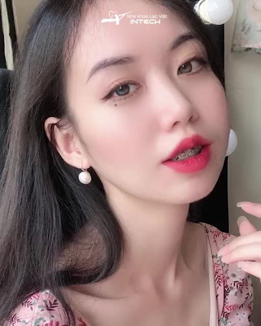 U là trời!! Niềng răng có thể giúp bạn thay đổi như thế này sao