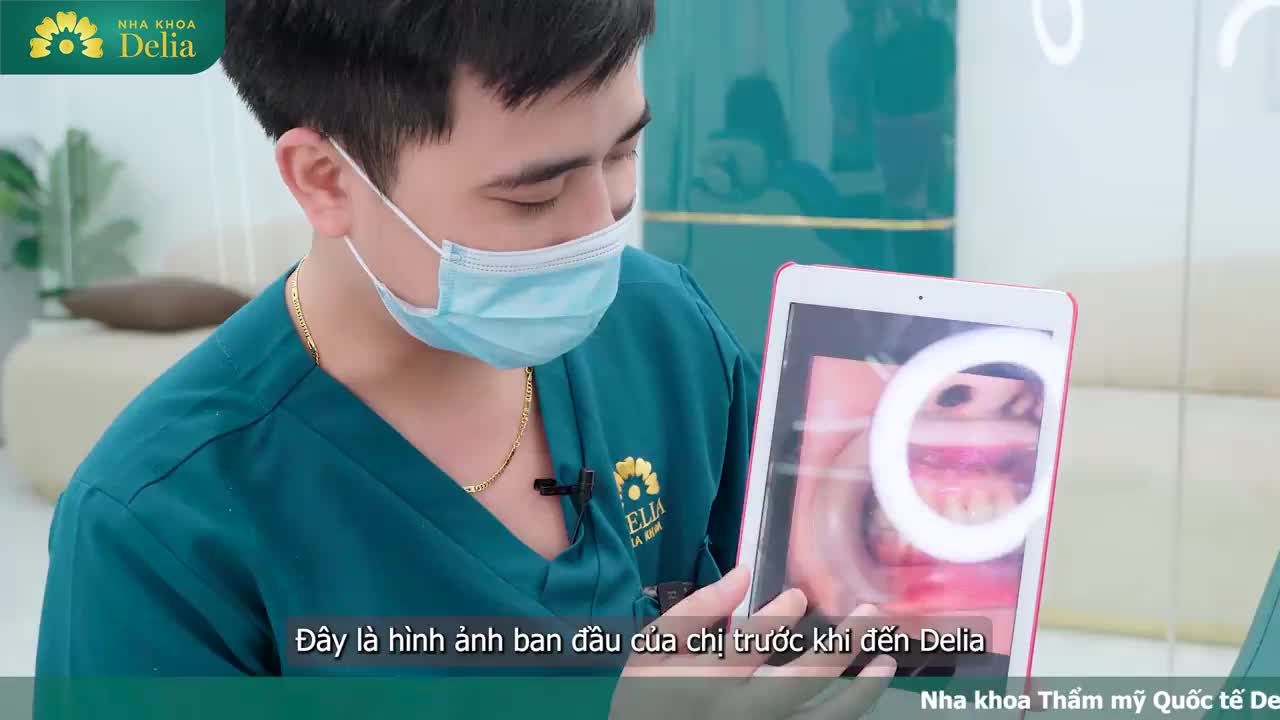 Việt kiều Đậu Thu Hằng gặp phải tình trạng Sứt mẻ, tụt nướu, nhiễm tetracycline