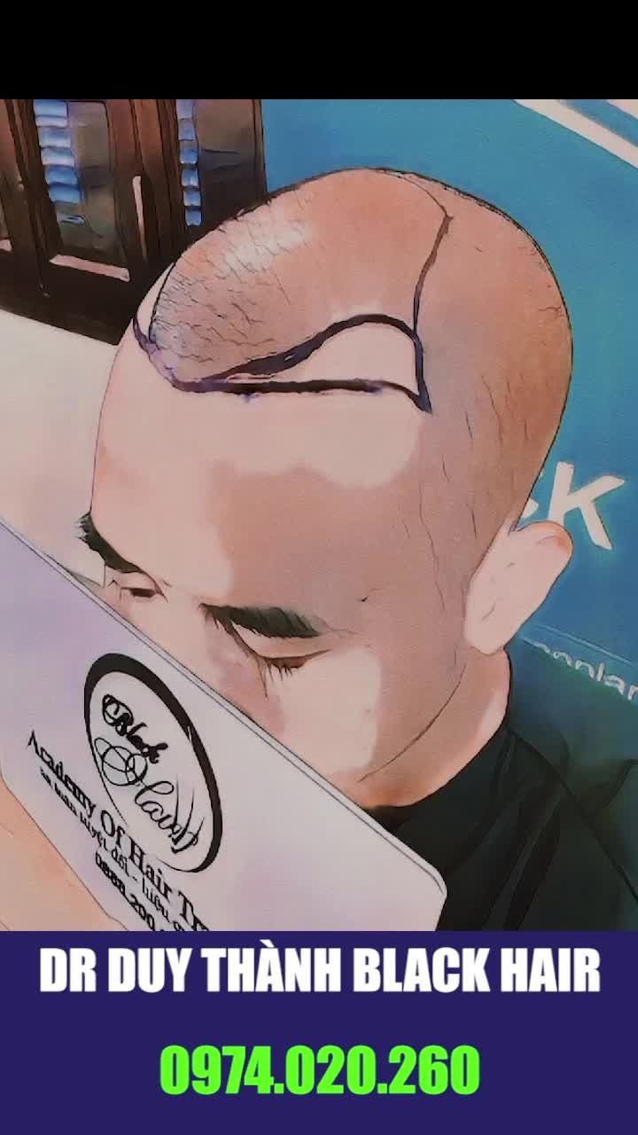 Cấy tóc tự thân nhẹ nhàng lắm nhé