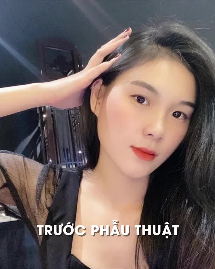 Bạn mong muốn có một nếp mí tự nhiên và đầy trẻ trung