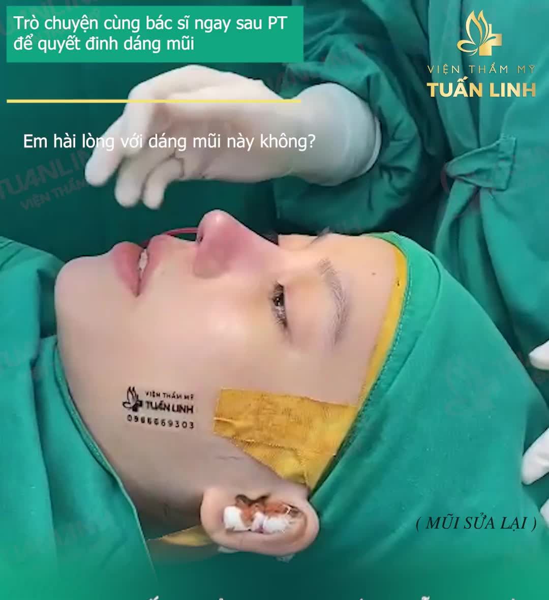 NÂNG MŨI SỬA LẠI = TÁI TẠO DÁNG MŨI ĐẸP HOÀN HẢO NGAY SAU 90 PHÚT