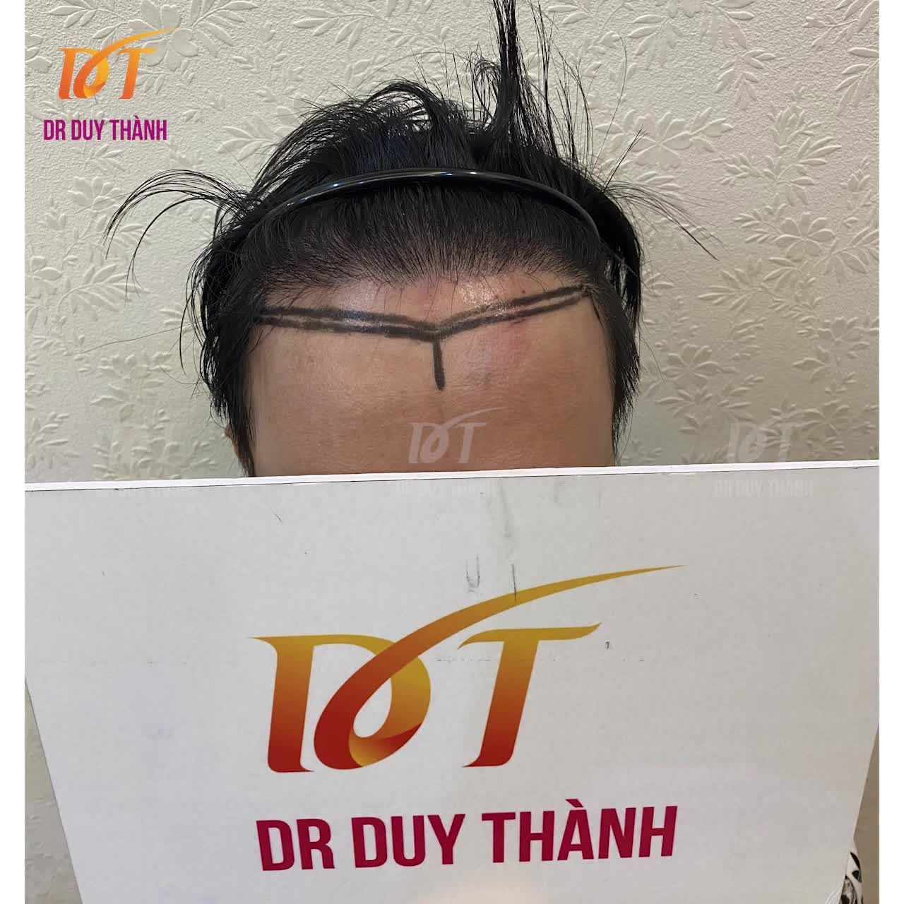 Thiết kế hairline mới trẻ trung hơn, thẩm mỹ hơn chỉ với 1300 nang tóc. Trước đó bạn có cấy 2000 nang tóc ở cơ sở khác.