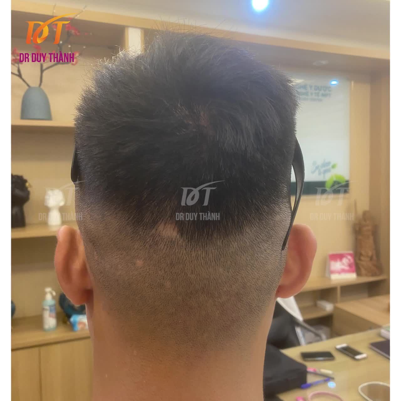 Video full Cấy 1200 nang tóc cho đại gia đất Thành Nam trẻ tuổi, khắc phục hói chữ M, không hạ đường chân tóc.