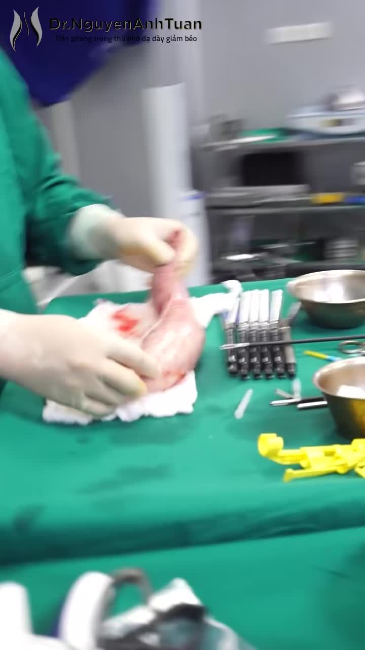 Để có được đường cắt phẳng lì, chuẩn và đảm bảo thẩm mỹ khi phẫu thuật nội soi thu nhỏ dạ dày là không hề dễ dàng.