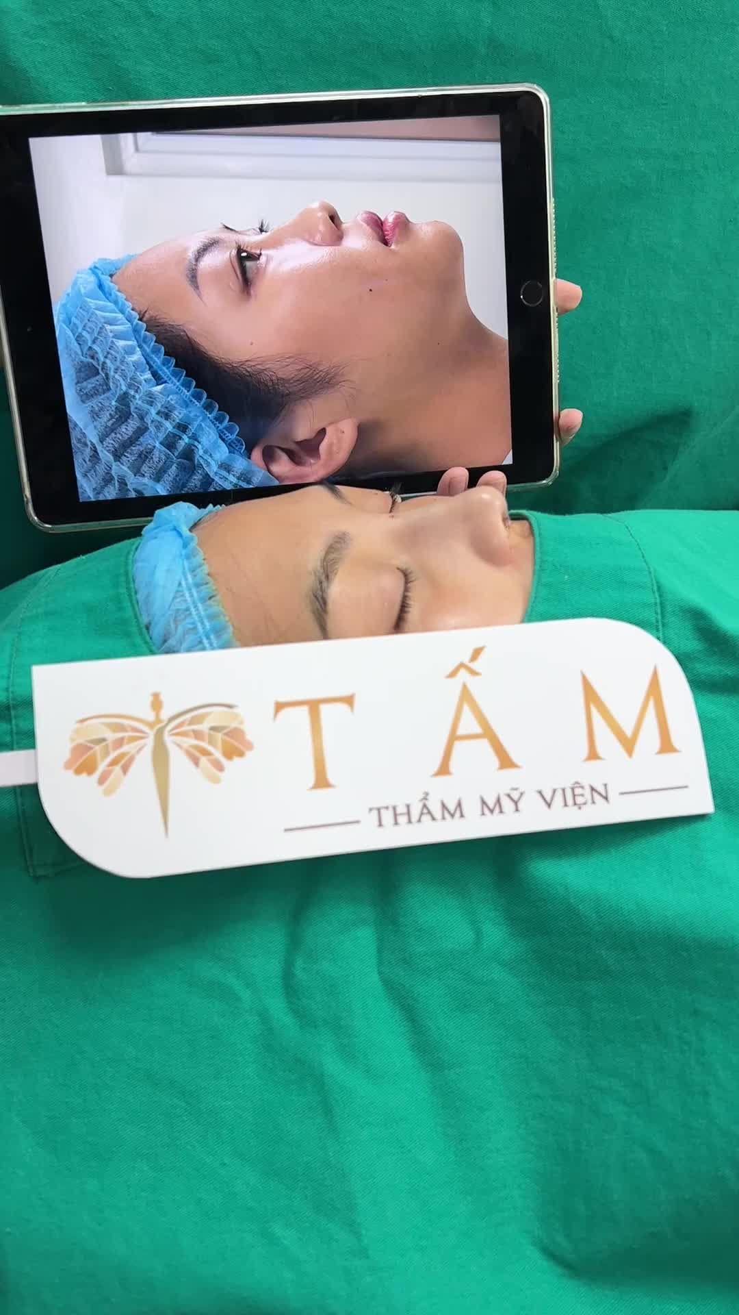 Kết quả hoàn thiện ca nâng mũi tại Thẩm mỹ viện Tấm